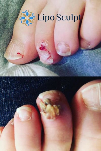 Wart removal customer results from Lipo Sculpt Wareham